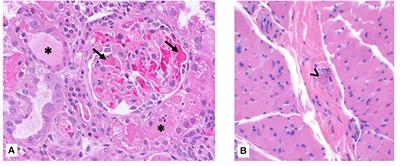 Case Report: Atypical HUS Presenting With Acute Rhabdomyolysis Highlights the Need for Individualized Eculizumab Dosing